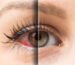 Why Does Weed Make Your Eyes Red and How to Get Rid of It?